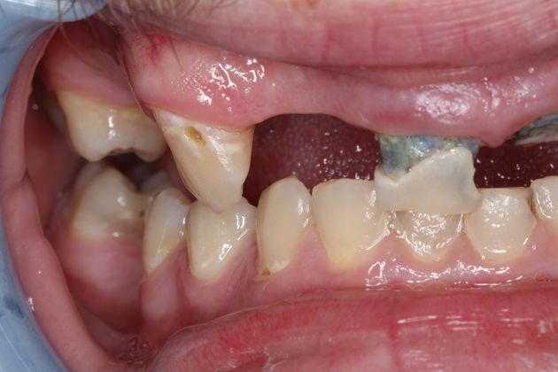 Dental Crowns: Case 31 - Before