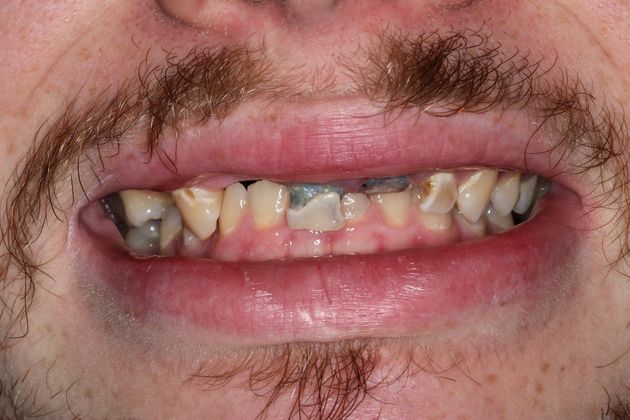 Dental Crowns Case 31 - Before