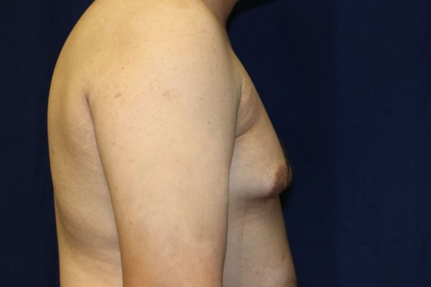 Male Breast Reduction*: Case 7 - Before