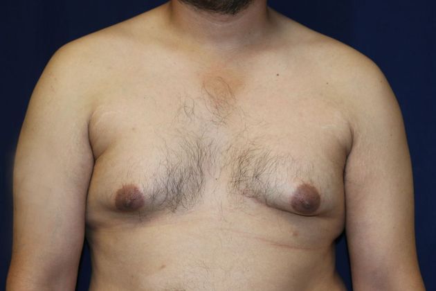 Male Breast Reduction*: Case 7 - Before
