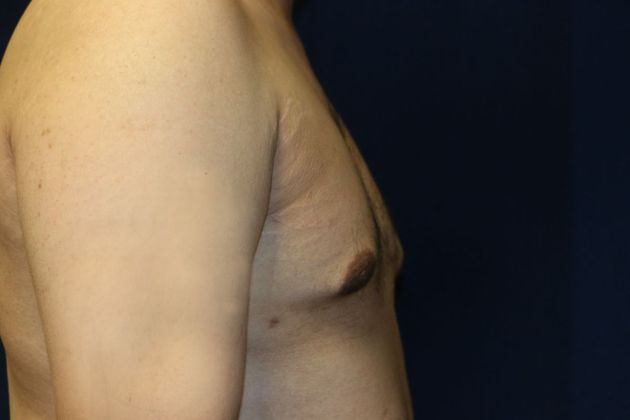 Male Breast Reduction*: Case 7 - After