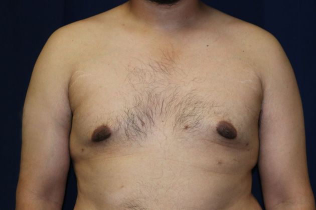 Male Breast Reduction*: Case 7 - After