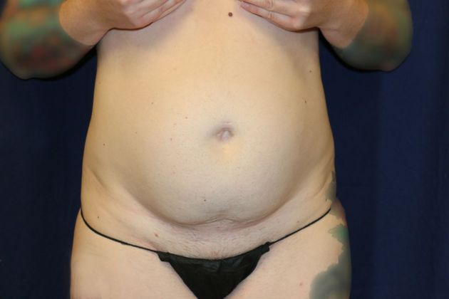 Liposuction & Safe Lipo: Case 49 - Before