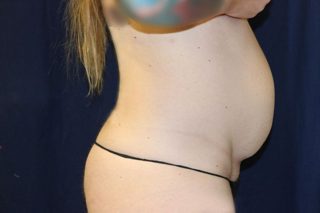Liposuction & Safe Lipo: Case 49 - Before
