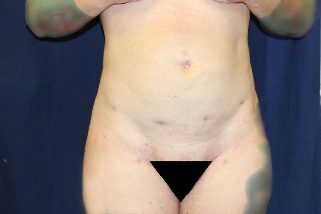 Liposuction & Safe Lipo: Case 49 - After