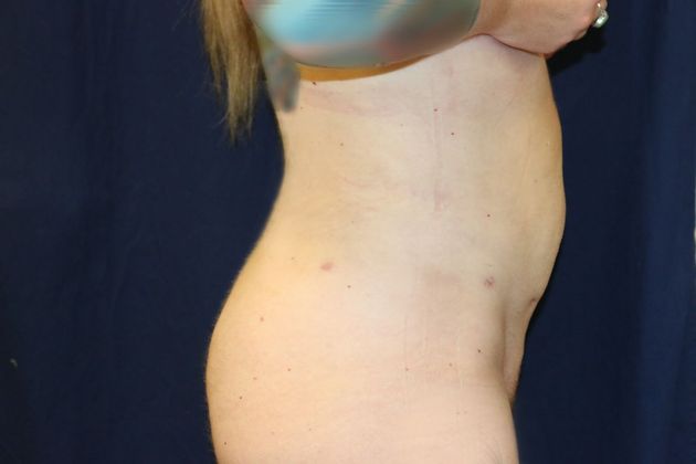Liposuction & Safe Lipo: Case 49 - After