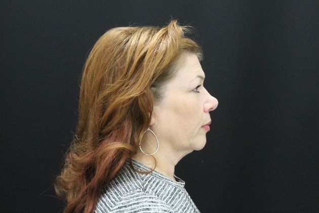 Face & Neck Lifts: Case 6 - Before