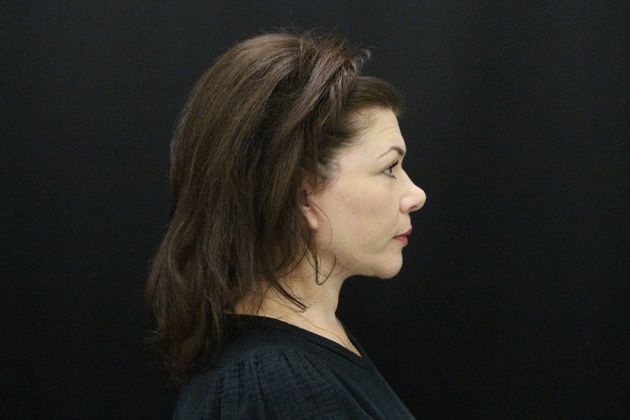 Face & Neck Lifts: Case 6 - After