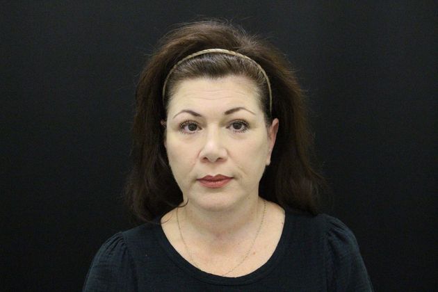 Face & Neck Lifts: Case 6 - Before