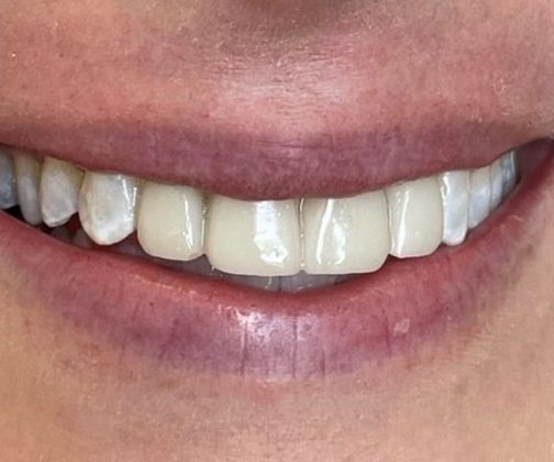 Porcelain Veneers: Case 16 - Before