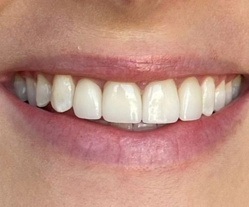 Porcelain Veneers: Case 16 - After