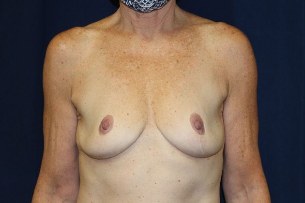 Breast Augmentation*: Case 66 - Before