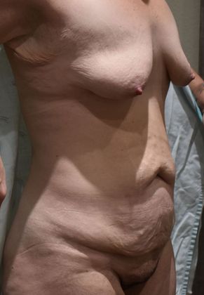 Mommy Makeover: Case 224 - Before