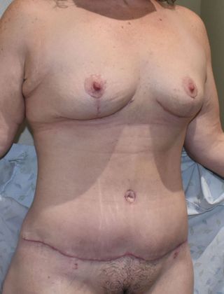 Mommy Makeover: Case 224 - After