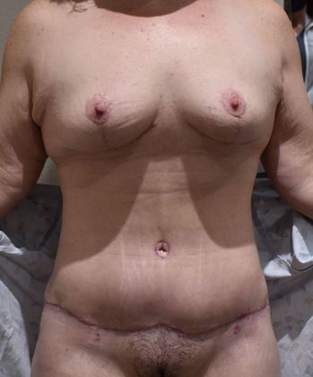 Mommy Makeover Case 224 - After