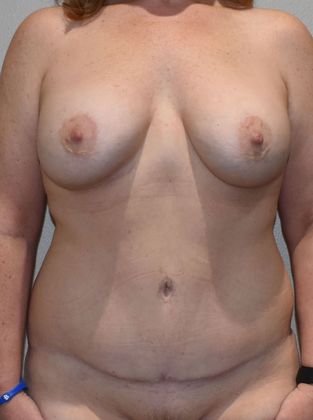 Mommy Makeover Case 225 - After