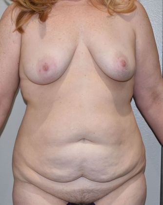 Mommy Makeover Case 225 - Before