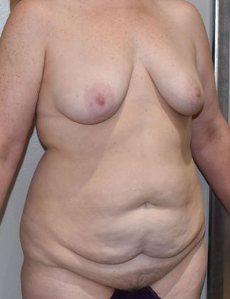 Mommy Makeover: Case 225 - Before