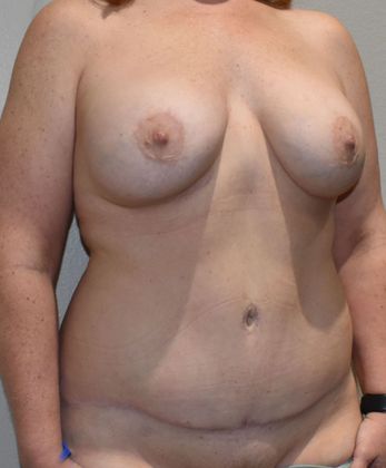 Mommy Makeover: Case 225 - After