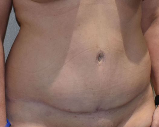Tummy Tuck (Abdominoplasty): Case 336 - After