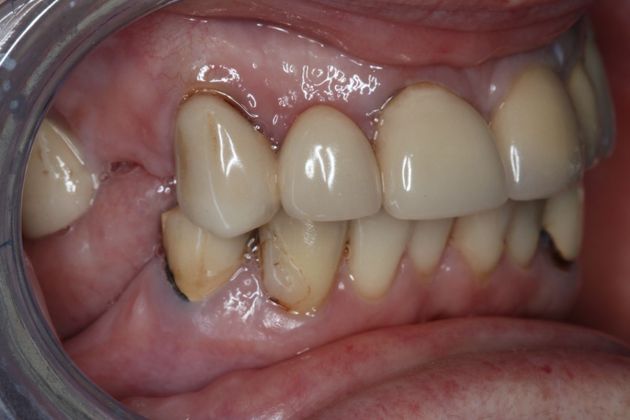 Dentures: Case 11 - Before