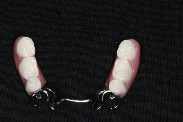 Dentures: Case 11 - Lower Partial Denture