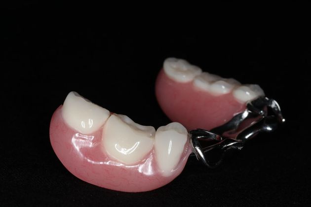 Dentures: Case 11 - Lower Partial Denture