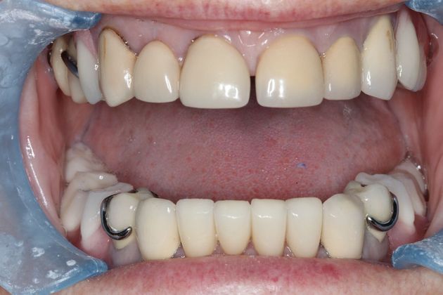 Dentures: Case 11 - After