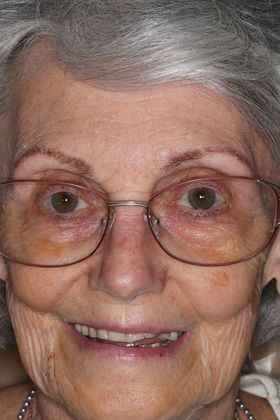 Dentures Case 12 - Before