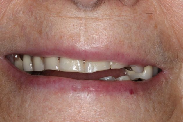 Dentures: Case 12 - Before