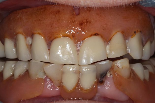 Dentures: Case 12 - Before
