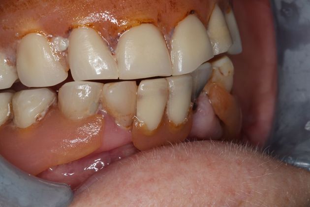 Dentures: Case 12 - Before