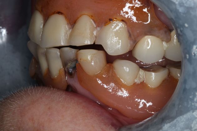 Dentures: Case 12 - Before