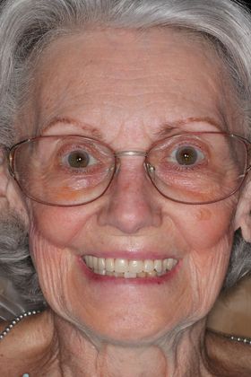 Dentures Case 12 - After