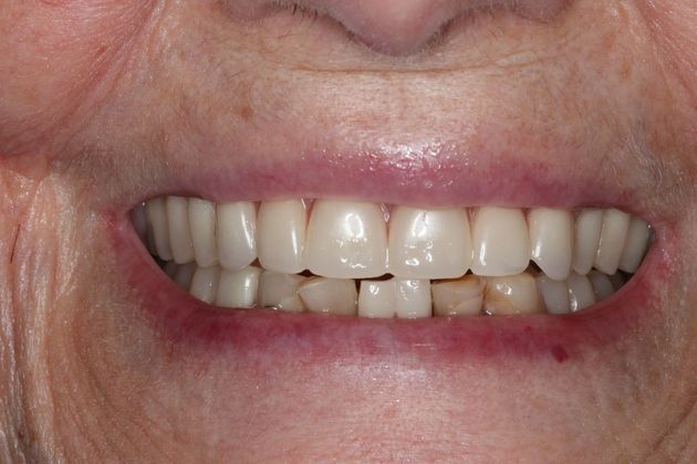 Dentures: Case 12 - After