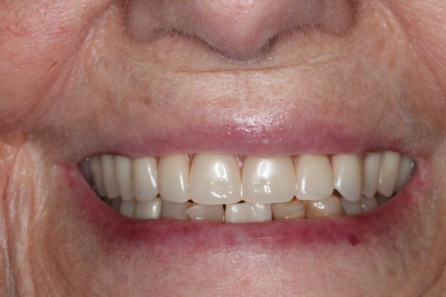 Dentures: Case 12 - After