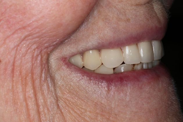 Dentures: Case 12 - After