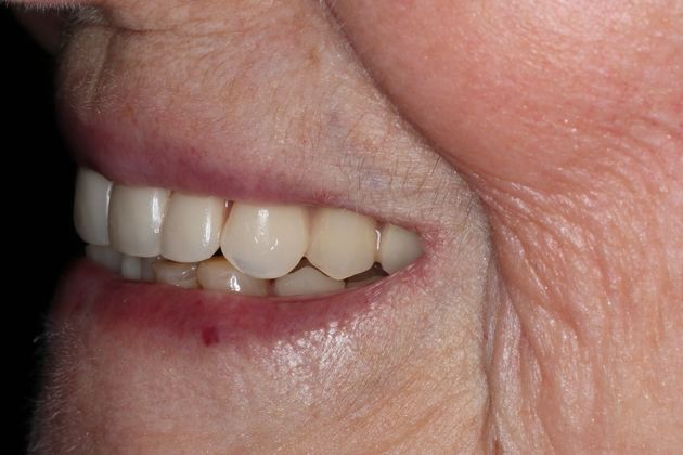 Dentures: Case 12 - After