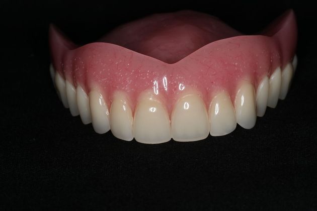 Dentures: Case 12 - Upper Denture
