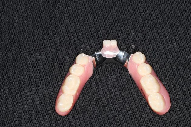 Dentures: Case 12 - Lower Partial Denture