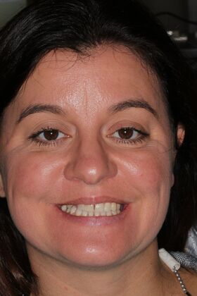 Veneers Case 23 - Before