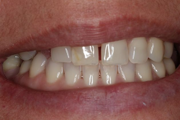 Veneers: Case 23 - Before