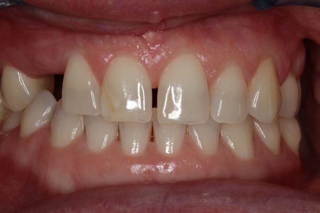 Veneers: Case 23 - Before
