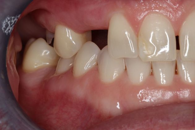 Veneers: Case 23 - Before