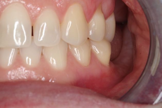 Veneers: Case 23 - Before