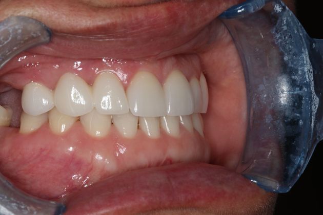 Veneers: Case 23 - After