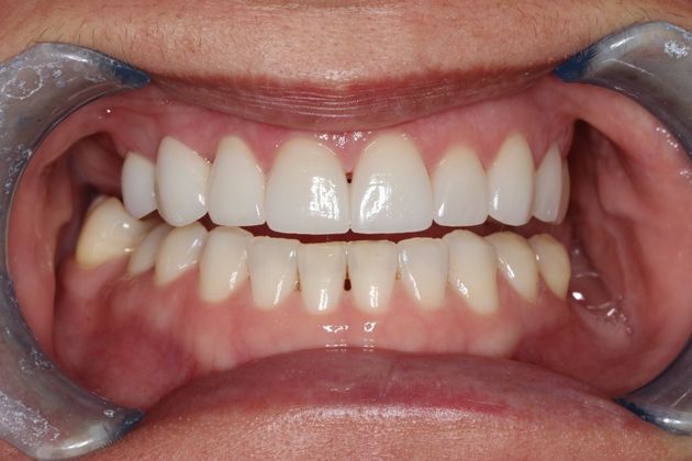 Veneers: Case 23 - After