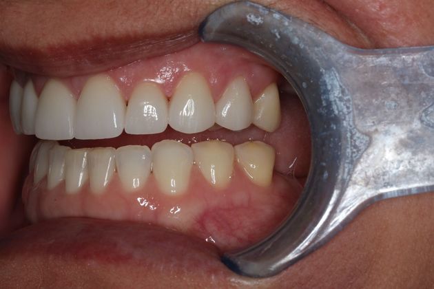 Veneers: Case 23 - After