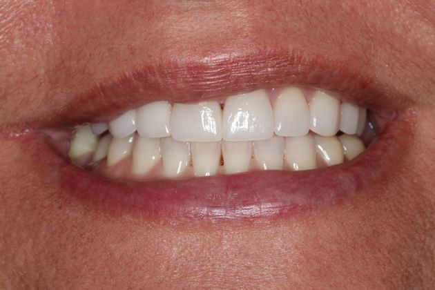 Veneers: Case 23 - After