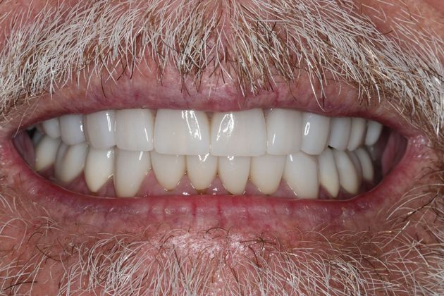 Full Mouth Reconstruction Case 8 - After